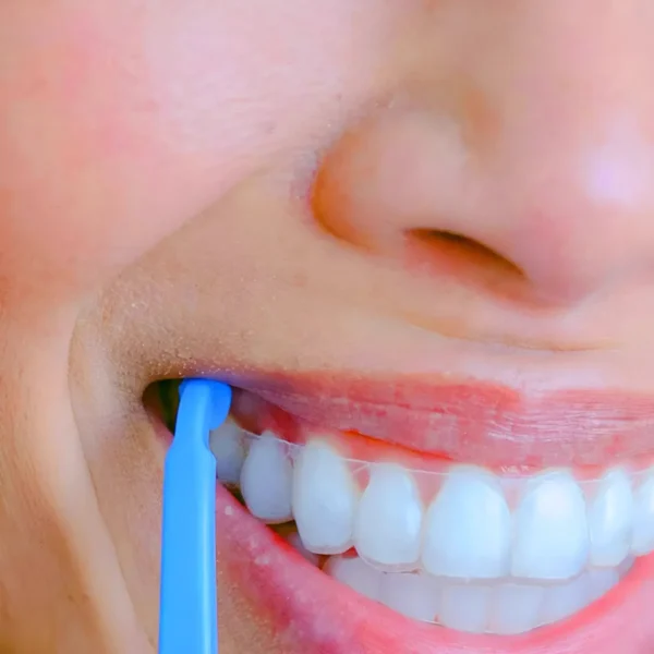 Invisalign removal tool or aligner hook